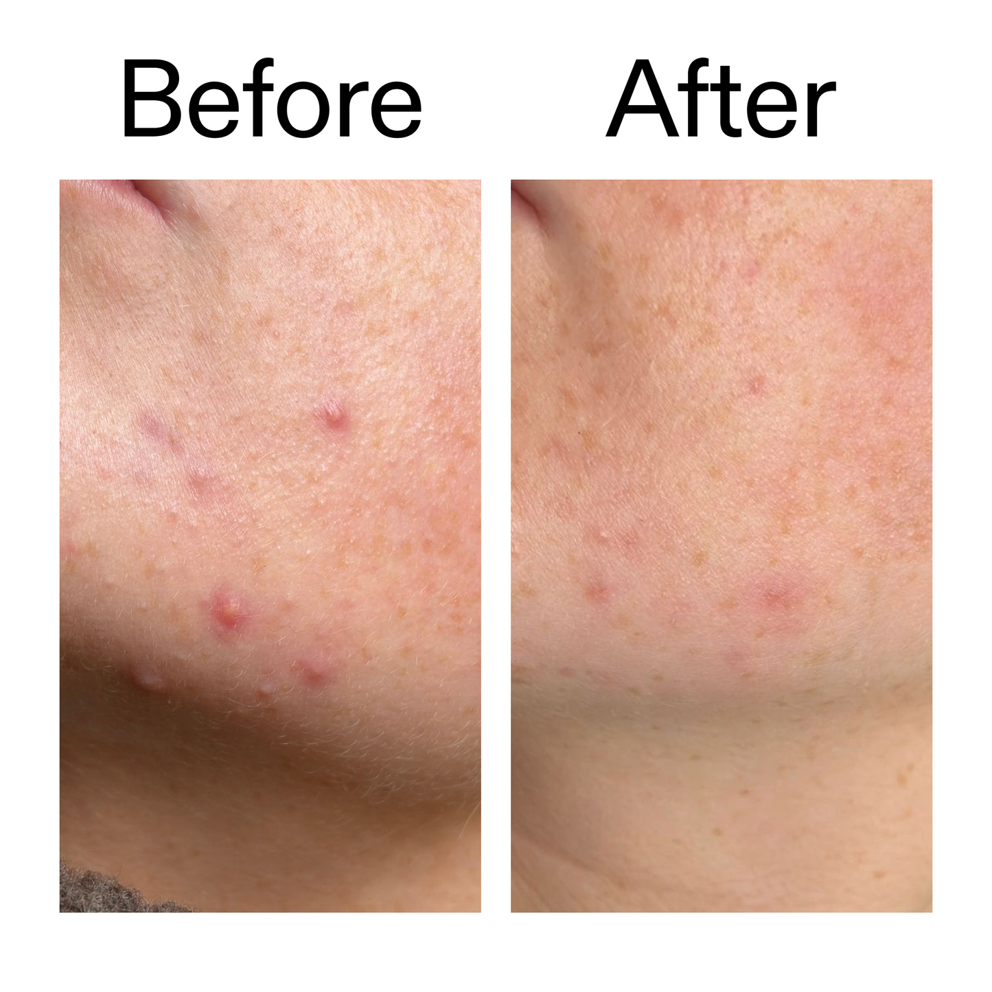 10-azelaic-acid-serum-for-redness-relief-v1 B_A_1_PPAGE.png