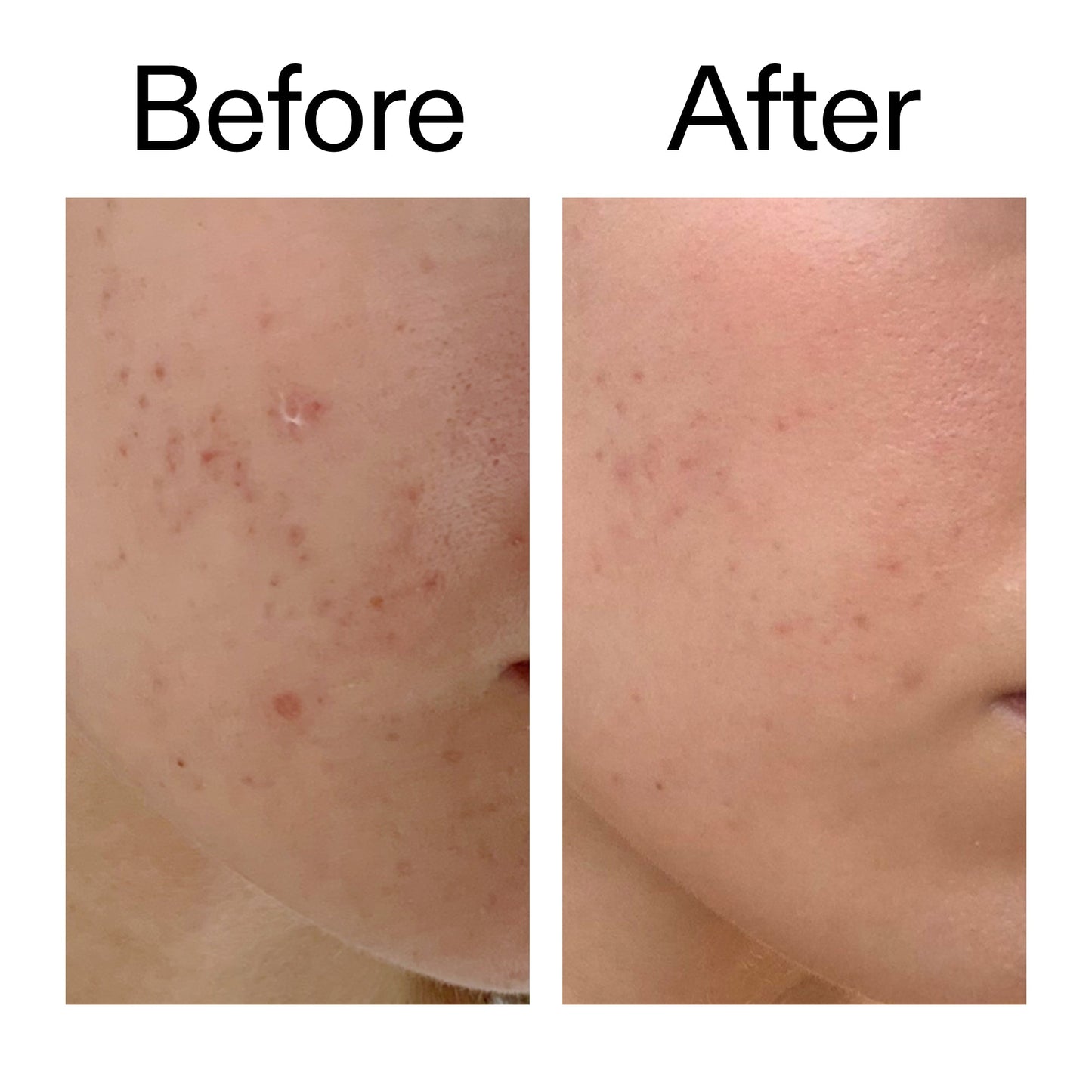 mandelic-acid-treatment-o5 Mandelic_Acid_Treatment_Before_After_2000x2000_4885ac6e-c5d7-4279-a72a-1417af7dce35.jpg