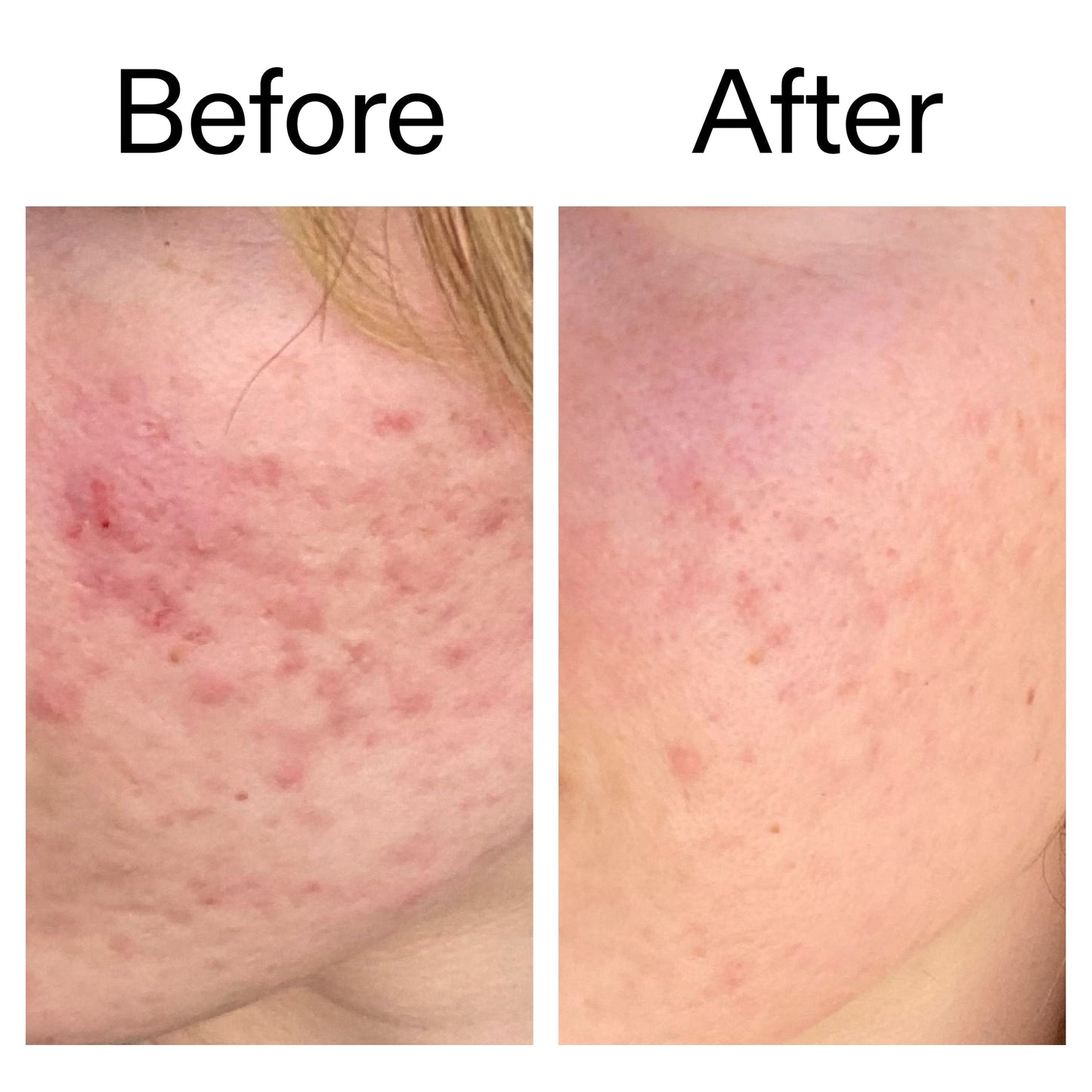 10-azelaic-acid-serum-for-redness-relief-v1 Azealic_Acid_Serum_B_A_Ppage_2000_x_2000.jpg