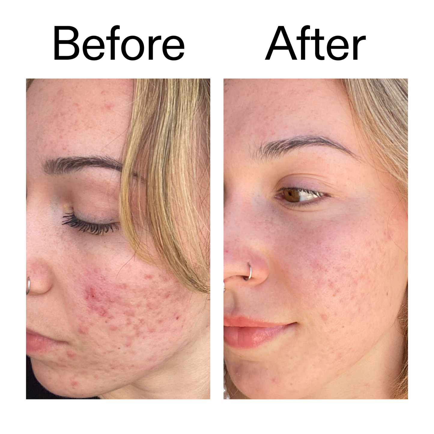 10-azelaic-acid-serum-for-redness-relief-v1 B_A_2_PPAGE.png