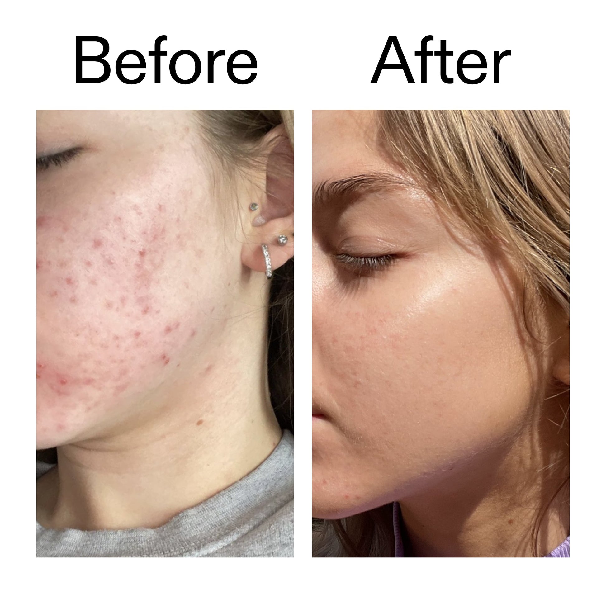 beta-hydroxy-acid-bha-serum-r8 Beta_Hydroxy_Acid_Serum_Before_After_2000x2000_96fda3e5-938d-49ef-bcf2-a0fa6ece4e2c.jpg