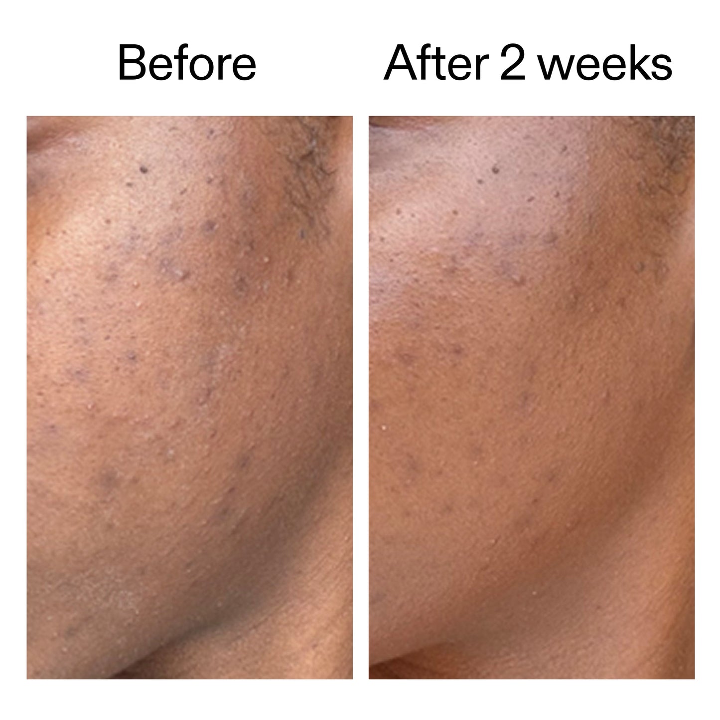 360-acne-clearing-duo-t9 DIOICB_A2000x2000.jpg