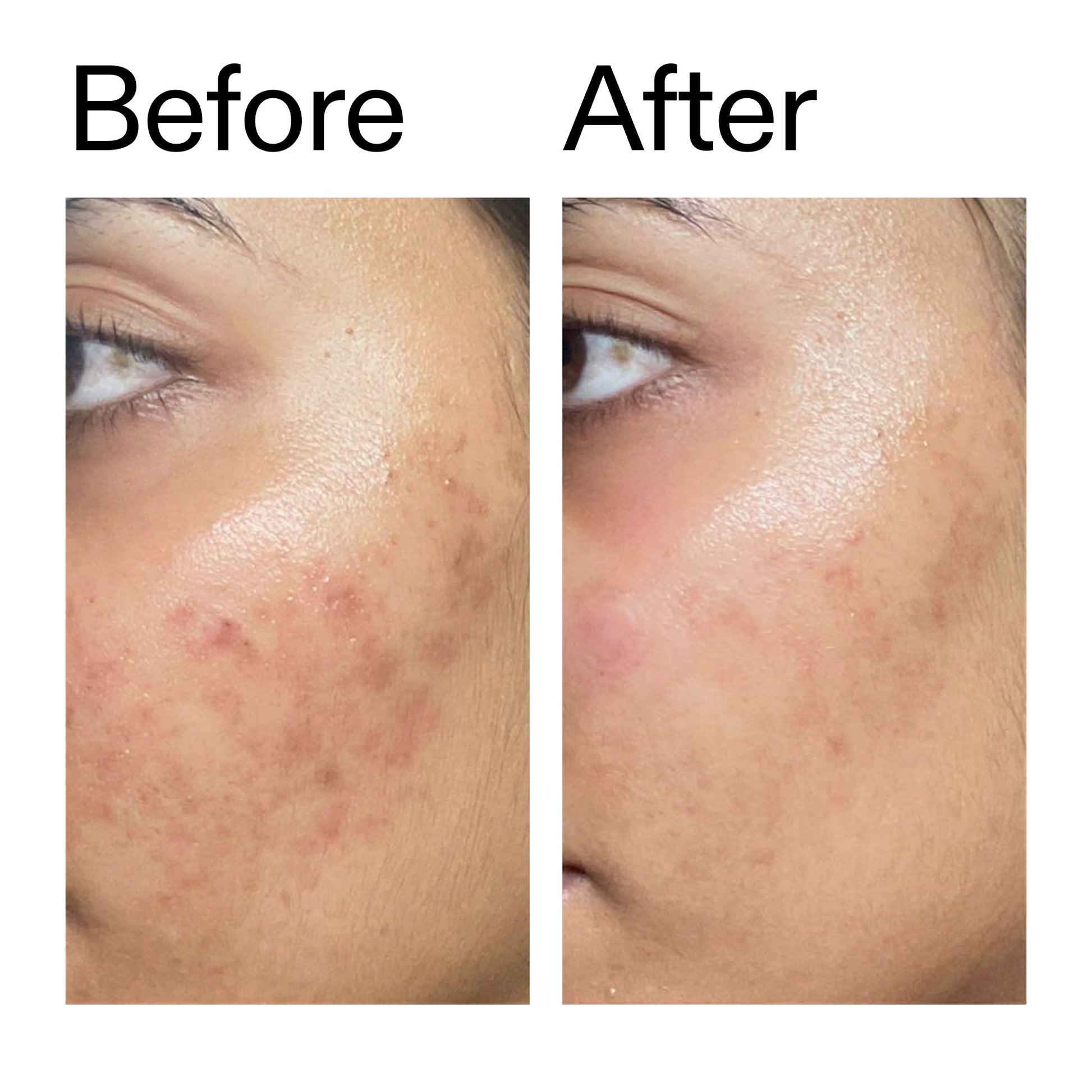 ectoin-hydro-barrier-serum-a0 Ectoin_Hydro-barrier_Serum__Before_After_2000x2000_34261920-d004-48d0-9c7b-8e1c15971bfd.jpg