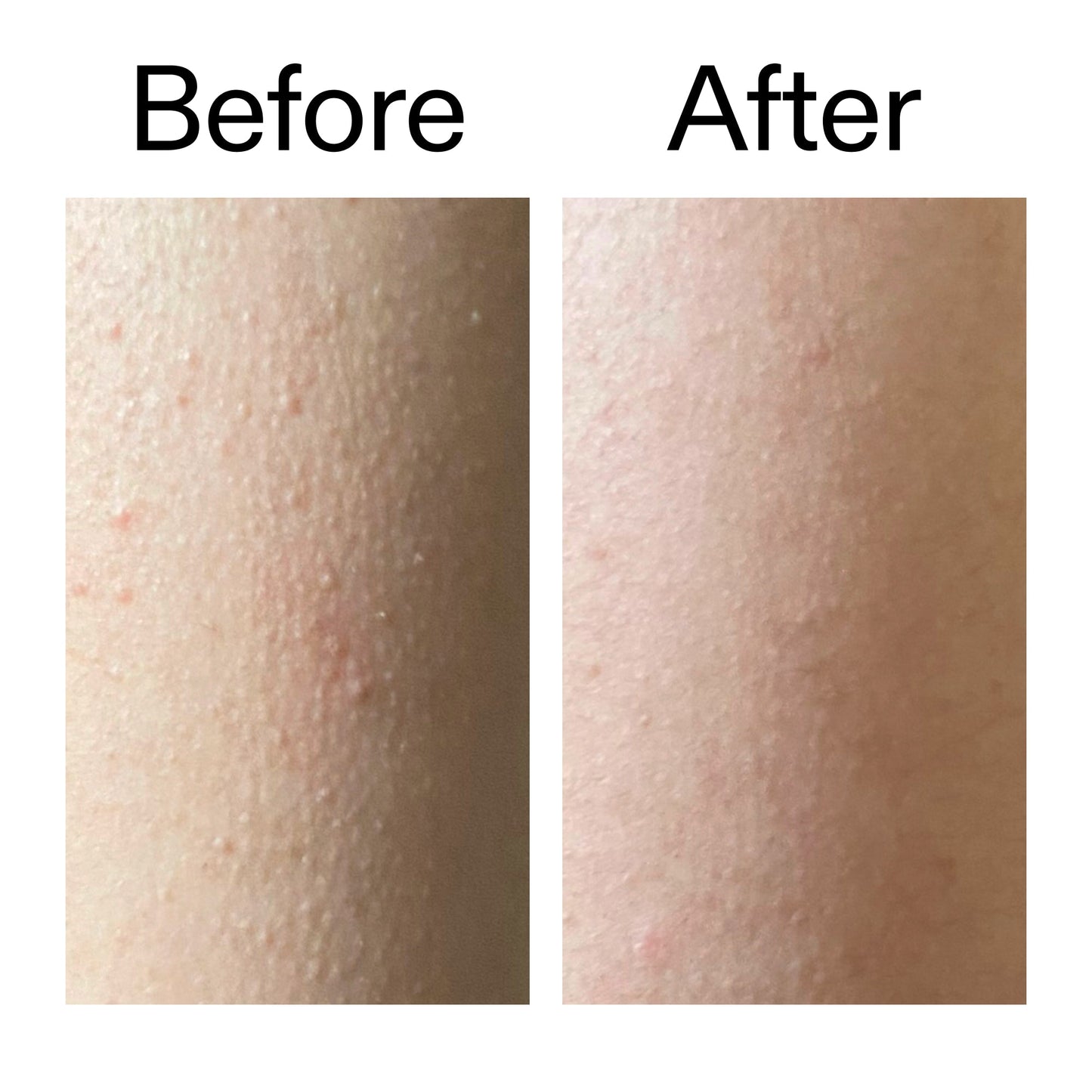 glycolic-acid-exfoliating-body-stick-duo-r9 Glycolic_Acid_Exfoliating_Body_Stick_Before_After_V2_2000x2000_2e4ba052-94f6-4d56-82df-7bdb5b2df7ae.jpg