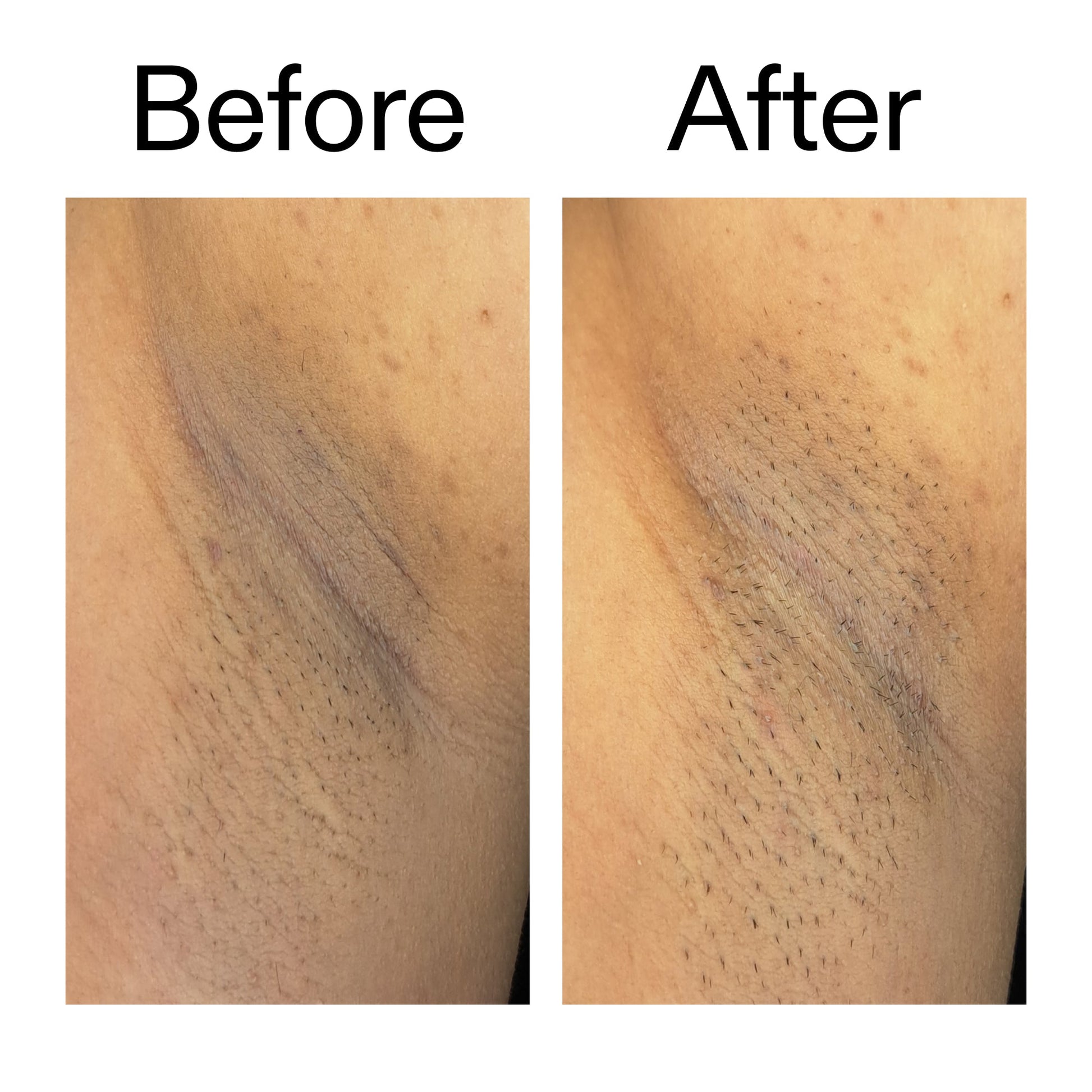 glycolic-acid-exfoliating-body-stick-c7 Glycolic_Acid_Exfoliating_Body_Stick_Before_After_V3_2000x2000_ea919cd9-1439-4a46-82a0-76200eb5bb42.jpg