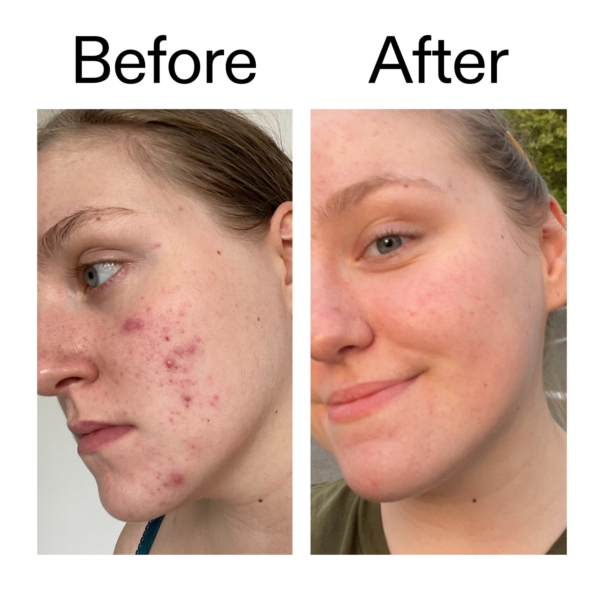 glycolic-acid-toner-t9 Glycolic_Acid_Toner_Before_After_2000x2000_49f0b9f7-e71b-4b2e-a8f8-2ea4b73247bb.jpg