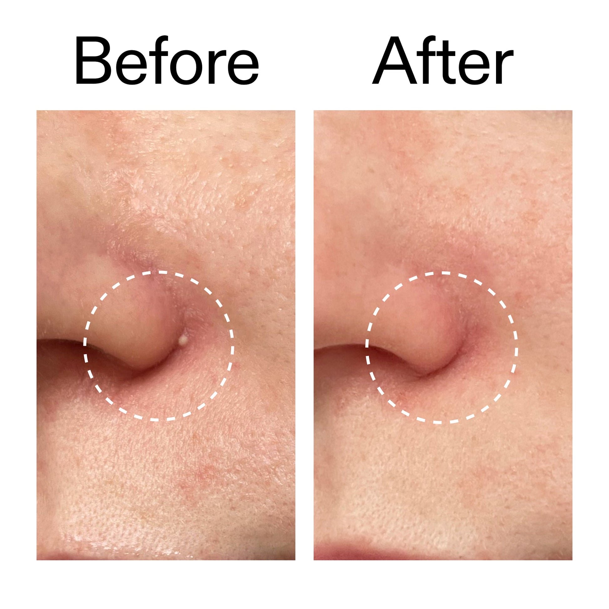 hydrocolloid-invisible-pimple-patches-pack-of-44-t7 Hydrocolloid_Invisible_Pimple_Patches_Before_After_2000x2000_b02aa37b-c78a-4682-91de-9135af5bb7df.jpg