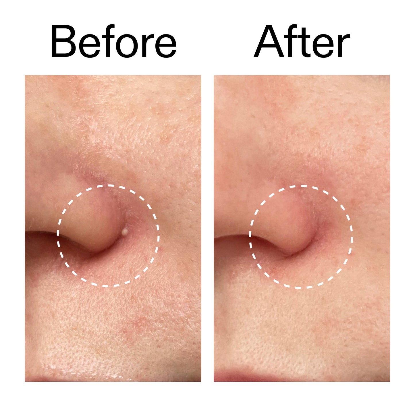 hydrocolloid-invisible-pimple-patches-pack-of-22-p3 Hydrocolloid_Invisible_Pimple_Patches_Before_After_2000x2000_b02aa37b-c78a-4682-91de-9135af5bb7df.jpg