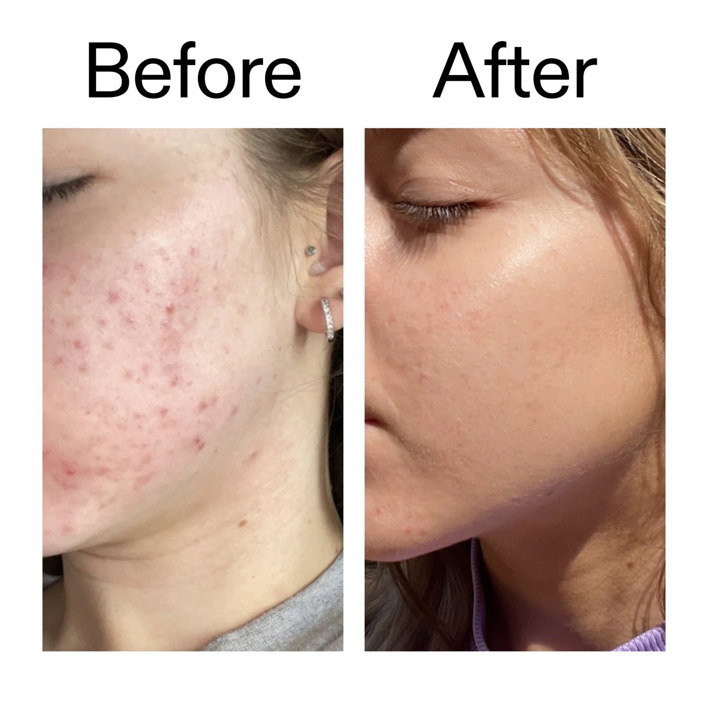 10-niacinamide-serum-duo-r3 Niacinamide_Serum_Before_After_2000x2000_bde32455-9e7d-448e-b053-bef41504f0a9.jpg