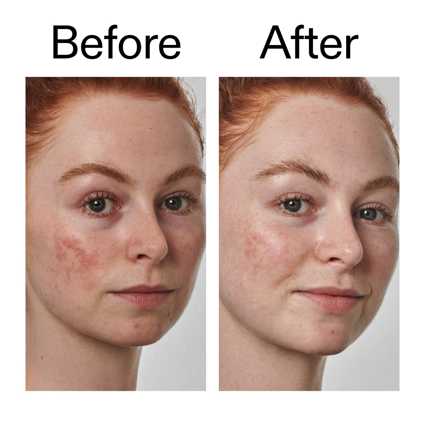 10-azelaic-acid-serum-for-redness-relief-v1 Redness_Relief_Serum_Before_After_2000x2000_3334dc9a-cce9-4e00-8aec-7ad89ca051f2.jpg