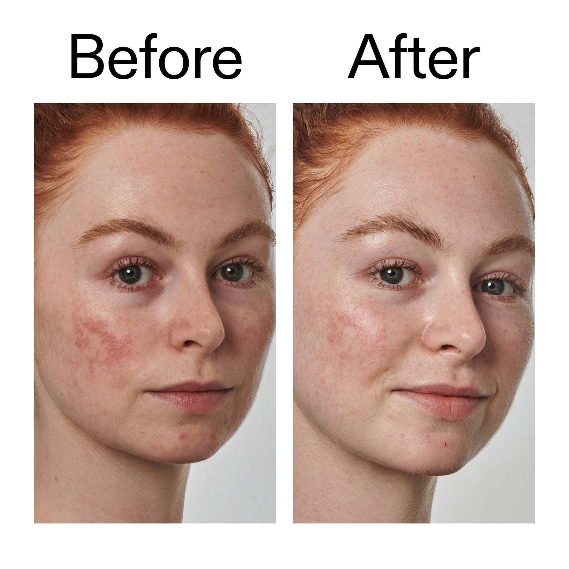 10-azelaic-acid-serum-for-redness-relief-v1 Redness_Relief_Serum_Before_After_2000x2000_3334dc9a-cce9-4e00-8aec-7ad89ca051f2.jpg