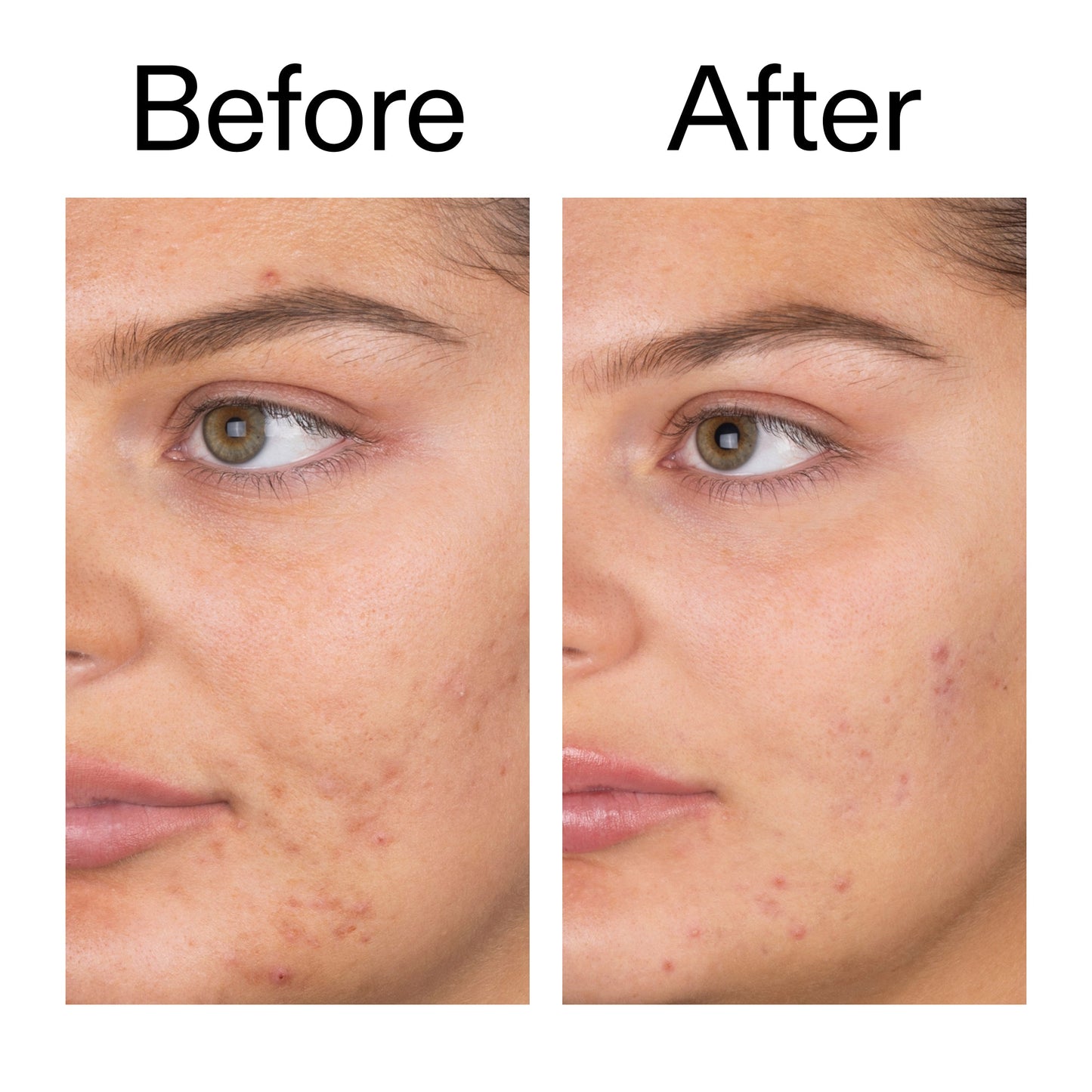 salicylic-acid-cleanser-duo-n9 Salicylic_Acid_Cleanser_-_150ml_Before_After_2000x2000_e7230494-853f-4b07-82b1-27669104c995.jpg