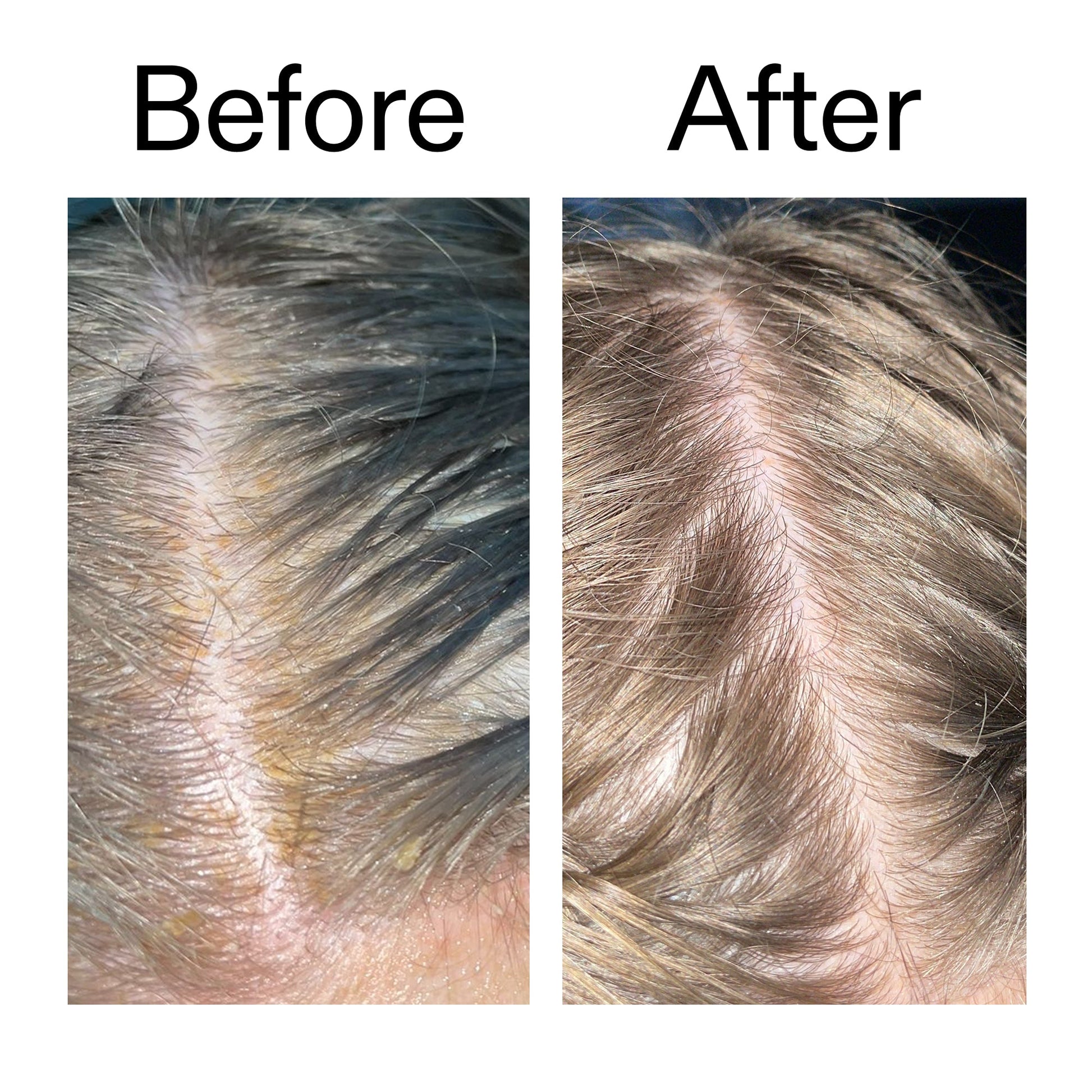 salicylic-acid-exfoliating-scalp-treatment-y4 Salicylic_Acid_Exfoliating_Scalp_Treatment_Before_After_2000x2000_e572a30f-057c-4a48-823b-1c09dc97f8d0.jpg