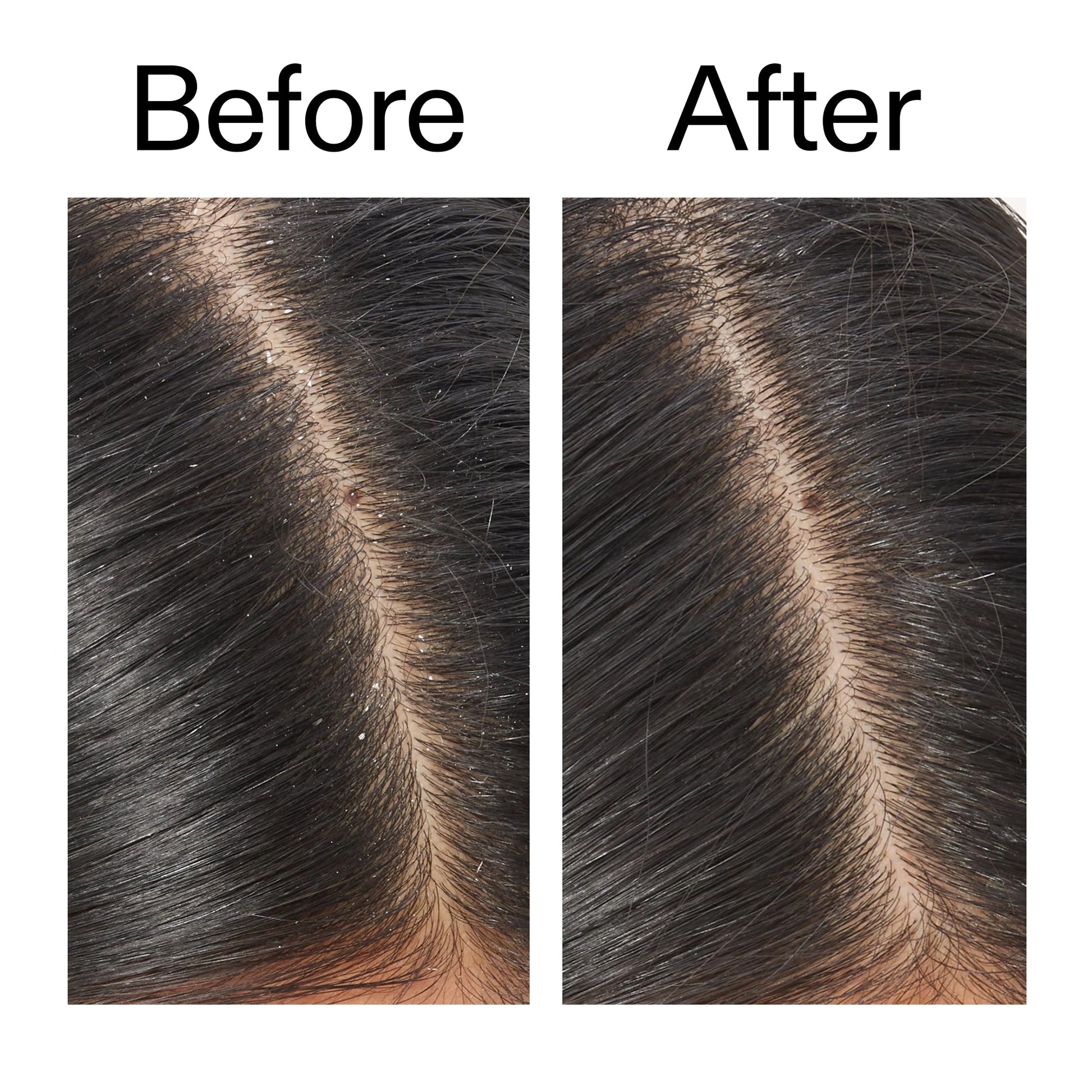 salicylic-acid-exfoliating-scalp-treatment-y4 Salicylic_Acid_Exfoliating_Scalp_Treatment_Before_After_V2_2000x2000_02bd61ad-42bf-490b-b3e3-7e04b2e8a673.jpg
