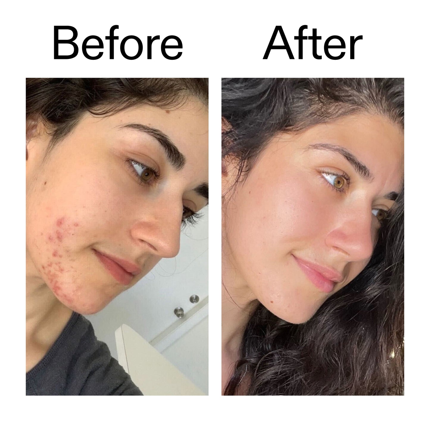 succinic-acid-acne-treatment-c4 Succinic_Acid_Treatment_Before_After_2000x2000_6a5f0054-2f58-4433-9314-0dc72c9bdd3b.jpg