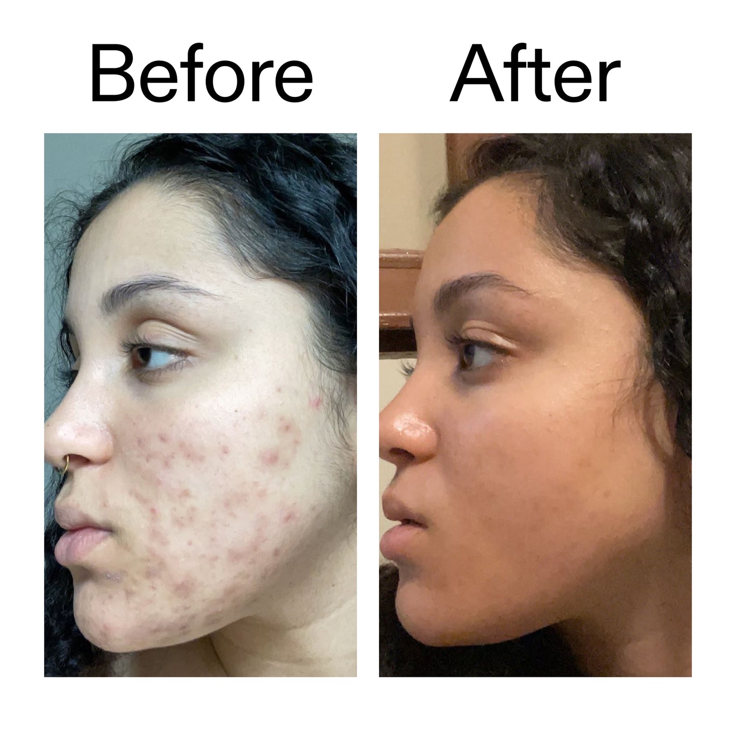 tranexamic-acid-serum-q0 Tranexamic_Acid_Serum_Before_After_2000x2000_98ebc8be-77b0-4843-8a22-90790ebe918b.jpg